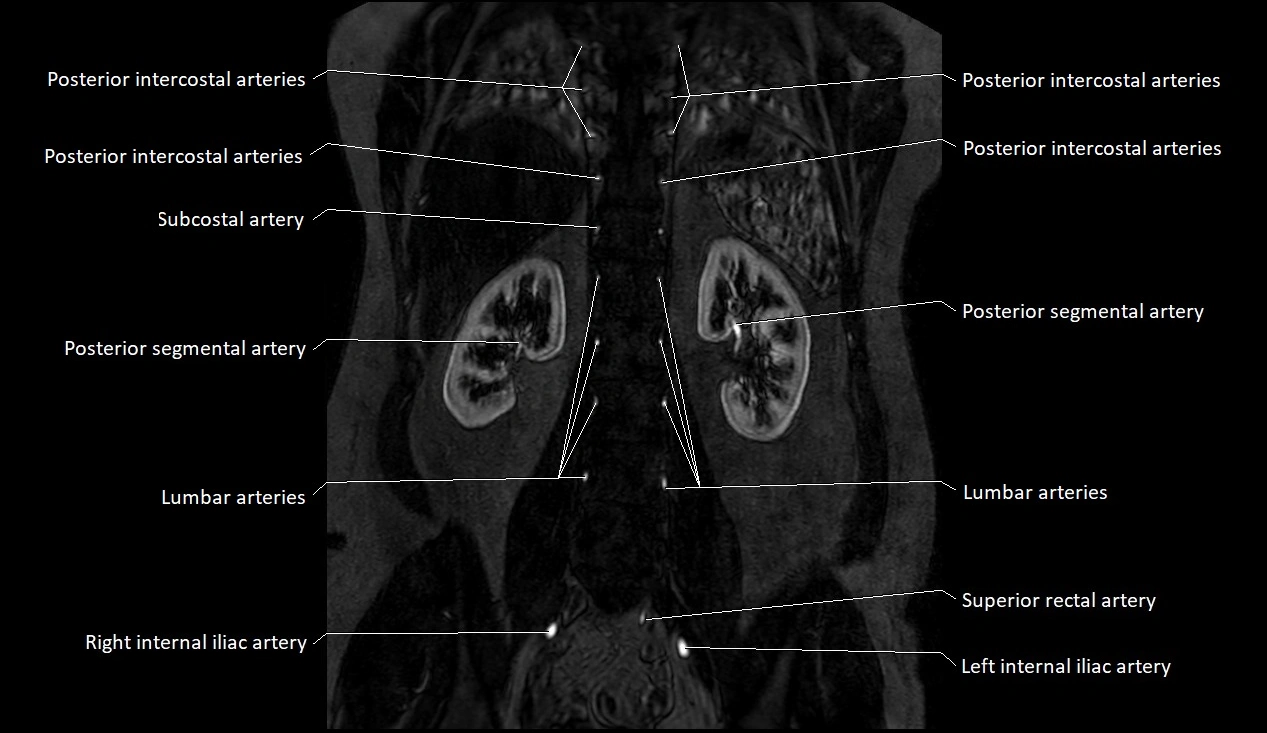 MRA Abdomen coronal anatomy image 41.webp